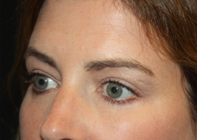 Blepharoplasty and Brow Lift Before & After Patient #20243