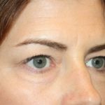 Blepharoplasty and Brow Lift Before & After Patient #20243