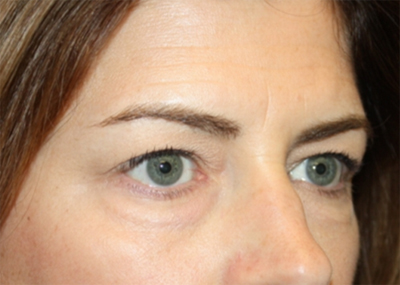 Blepharoplasty and Brow Lift Before & After Patient #20243