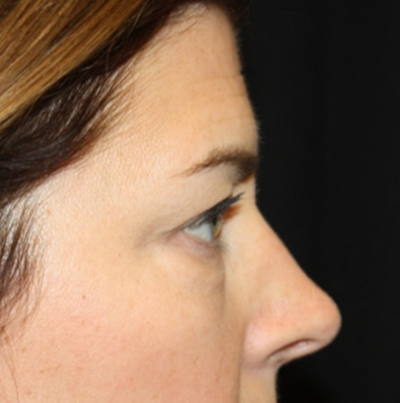 Blepharoplasty and Brow Lift Before & After Patient #20243