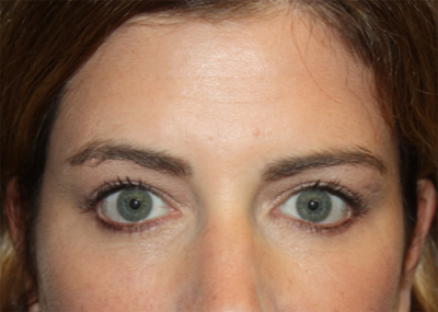 Blepharoplasty and Brow Lift Before & After Patient #20243