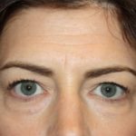 Blepharoplasty and Brow Lift Before & After Patient #20243