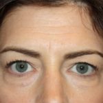 Blepharoplasty and Brow Lift Before & After Patient #20243