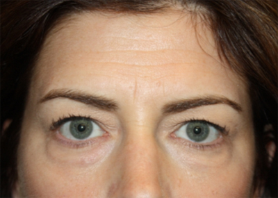 Blepharoplasty and Brow Lift Before & After Patient #20243