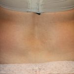 Liposuction Before & After Patient #21425