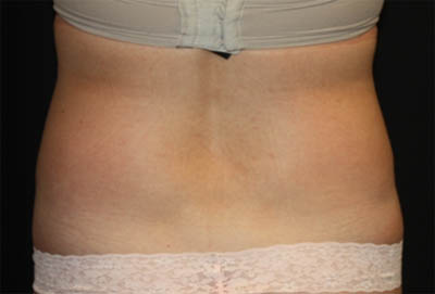 Liposuction Before & After Patient #21425