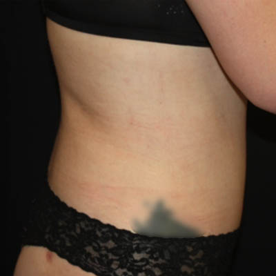 Liposuction Before & After Patient #21425