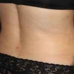 Liposuction Before & After Patient #21425