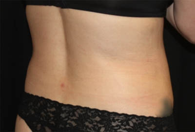 Liposuction Before & After Patient #21425