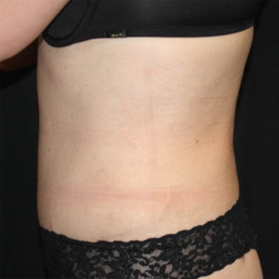 Liposuction Before & After Patient #21425