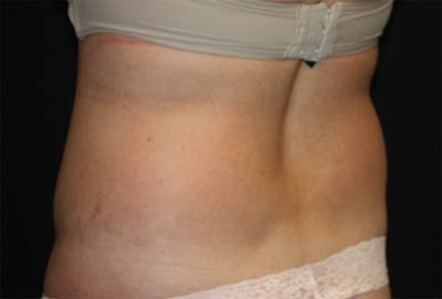 Liposuction Before & After Patient #21425