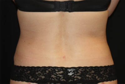 Liposuction Before & After Patient #21425