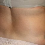 Liposuction Before & After Patient #21425