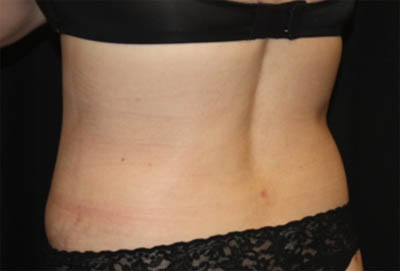 Liposuction Before & After Patient #21425