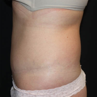 Liposuction Before & After Patient #21425