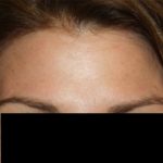 Botox and Dysport Before & After Patient #24764