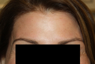 Botox and Dysport Before & After Patient #24764