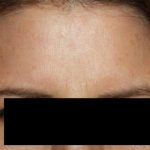 Botox and Dysport Before & After Patient #24764