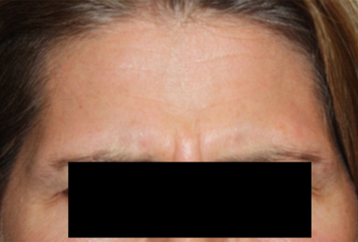 Botox and Dysport Before & After Patient #24764