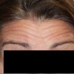 Botox and Dysport Before & After Patient #24764