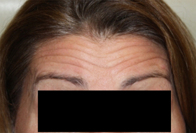 Botox and Dysport Before & After Patient #24764