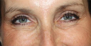 Botox and Dysport Before & After Patient #24765