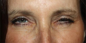 Botox and Dysport Before & After Patient #24765