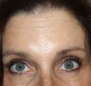 Botox and Dysport Before & After Patient #24765