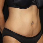 Tummy Tuck Before & After Patient #22756