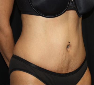 Tummy Tuck Before & After Patient #22756