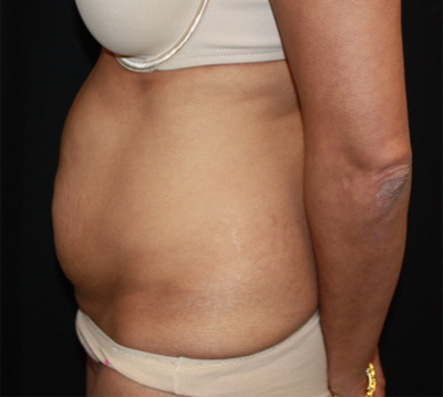 Tummy Tuck Before & After Patient #22756