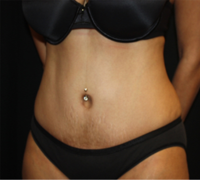 Tummy Tuck Before & After Patient #22756