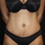 Tummy Tuck Before & After Patient #22756