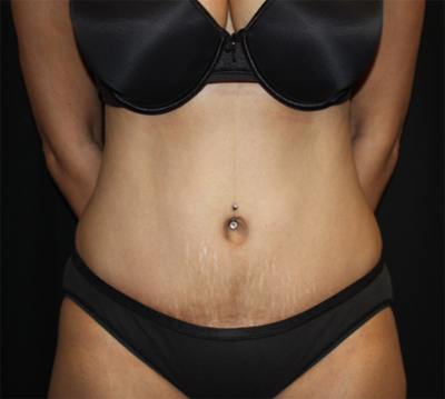 Tummy Tuck Before & After Patient #22756