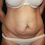 Tummy Tuck Before & After Patient #22756