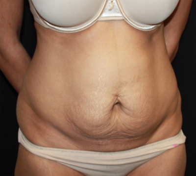 Tummy Tuck Before & After Patient #22756