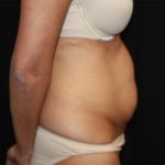 Tummy Tuck Before & After Patient #22756