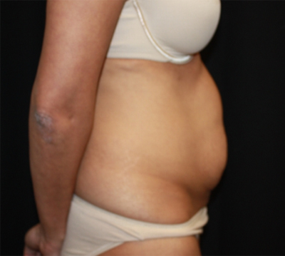 Tummy Tuck Before & After Patient #22756