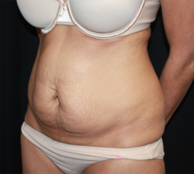 Tummy Tuck Before & After Patient #22756