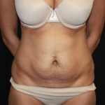 Tummy Tuck Before & After Patient #22756