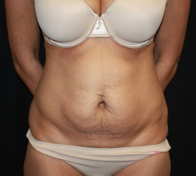 Tummy Tuck Before & After Patient #22756