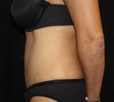 Tummy Tuck Before & After Patient #22756