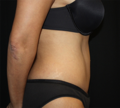 Tummy Tuck Before & After Patient #22756