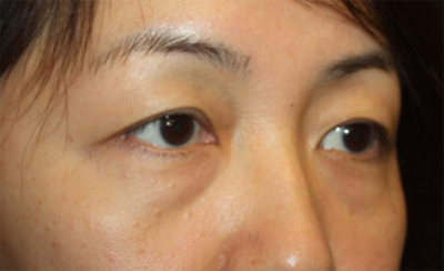 Blepharoplasty Before & After Patient #20163