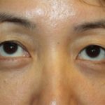 Blepharoplasty Before & After Patient #20163
