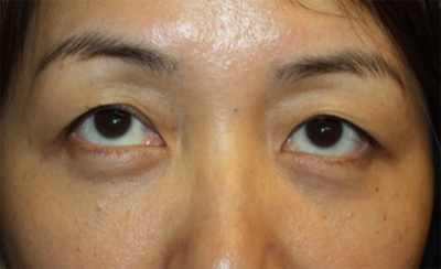 Blepharoplasty Before & After Patient #20163