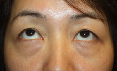 Blepharoplasty Before & After Patient #20163