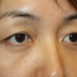 Blepharoplasty Before & After Patient #20163