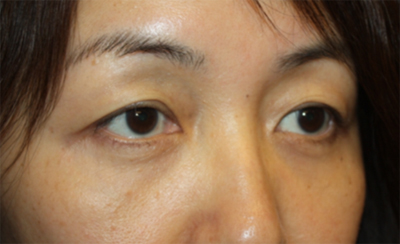 Blepharoplasty Before & After Patient #20163