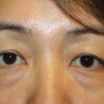 Blepharoplasty Before & After Patient #20163